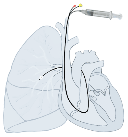 Схема анатомии правых отделов сердца с введённым катетером Свана-Ганца