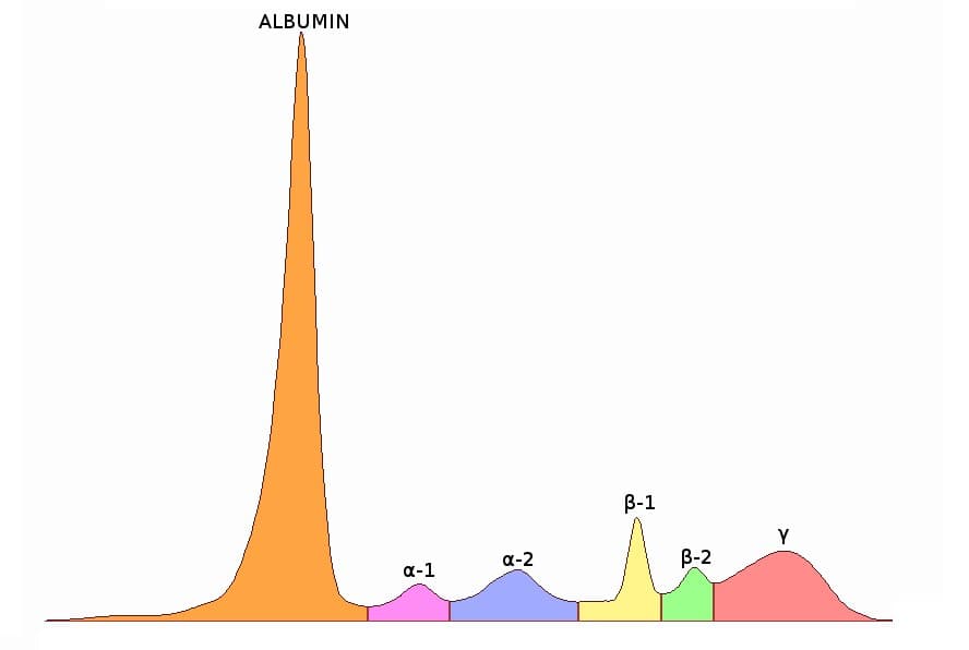 Gráfico de eletroforese de proteínas séricas com picos coloridos por fração.