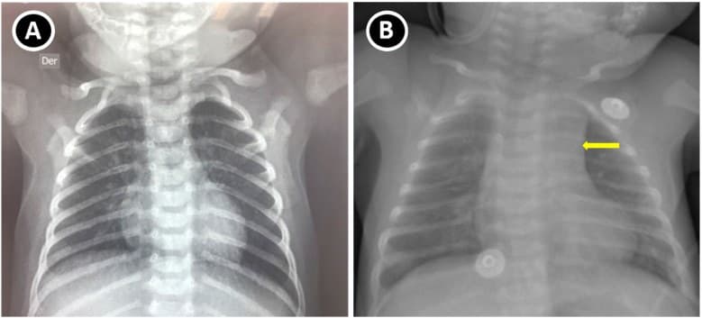 Radiografia de tórax de lactente sem a sombra do timo no mediastino superior.