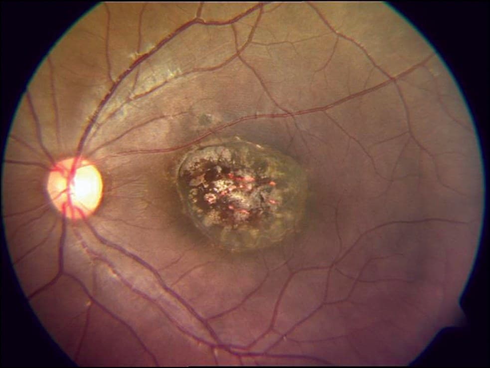 Fotografia de fundo de olho com lesão cicatricial arredondada e pigmentada na mácula.