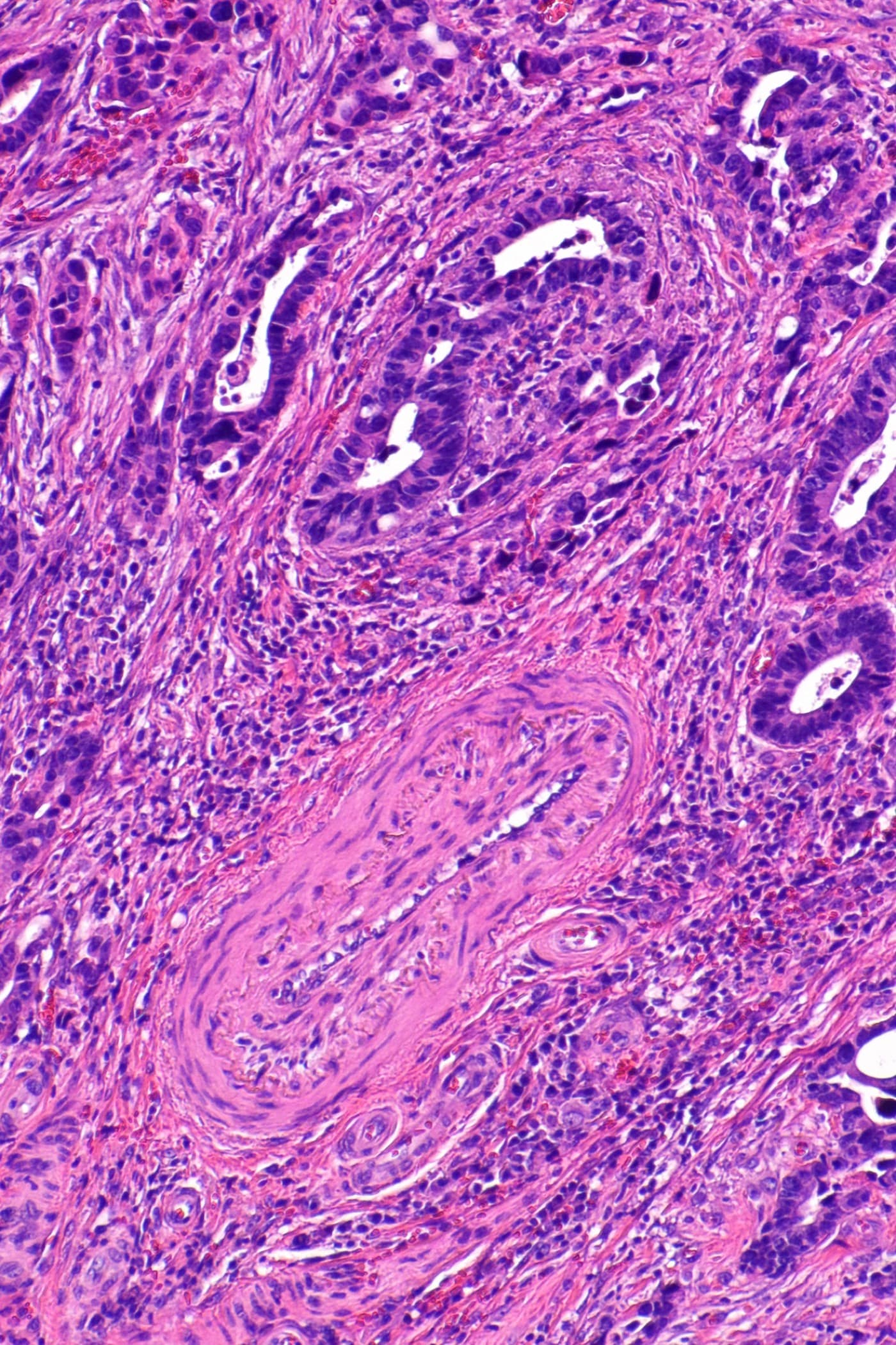 Histology slide of colon adenocarcinoma