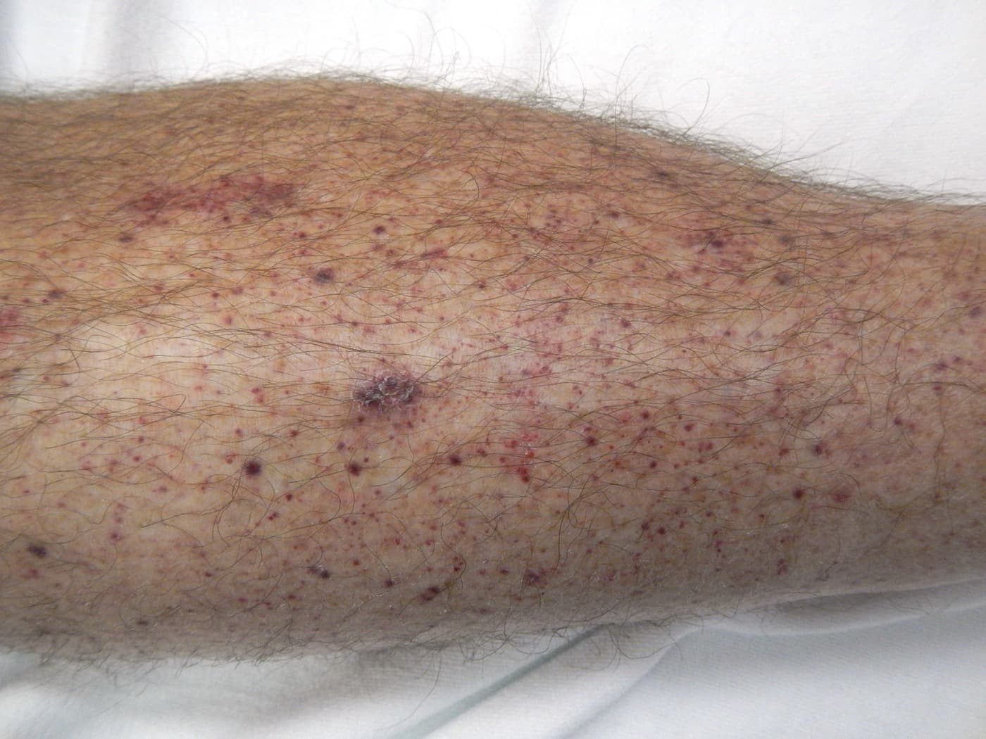 Physical exam showing petechiae