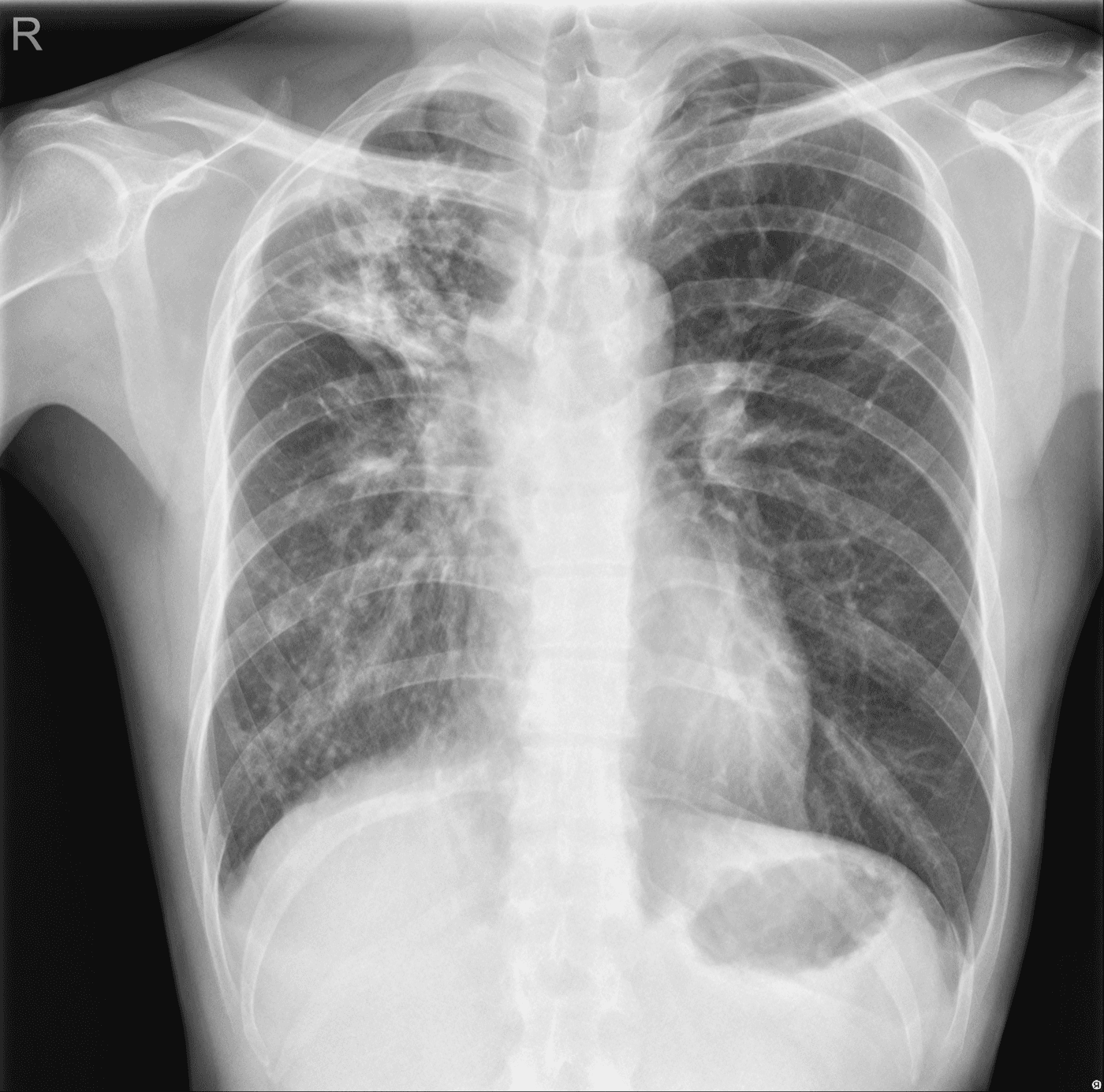 Chest X-ray showing bilateral pulmonary tuberculosis